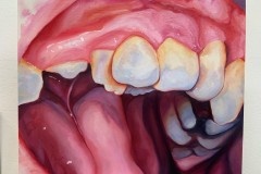 A realistic painting in warm reds and pinks depicts a close up of the mouth of a child who has lost a tooth. The remaining teeth are crooked and clustered together.